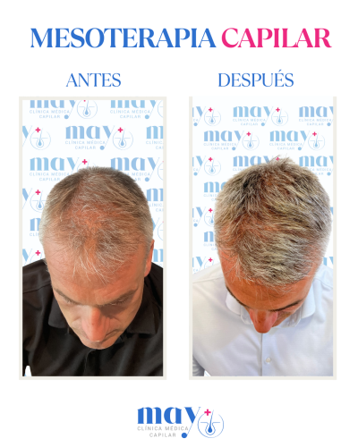 CASO 1 MESOTERAPIA